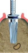Implants Toulouse 31