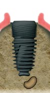 Implant Toulouse 31000